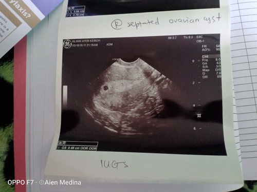 Tekanan darah tinggi