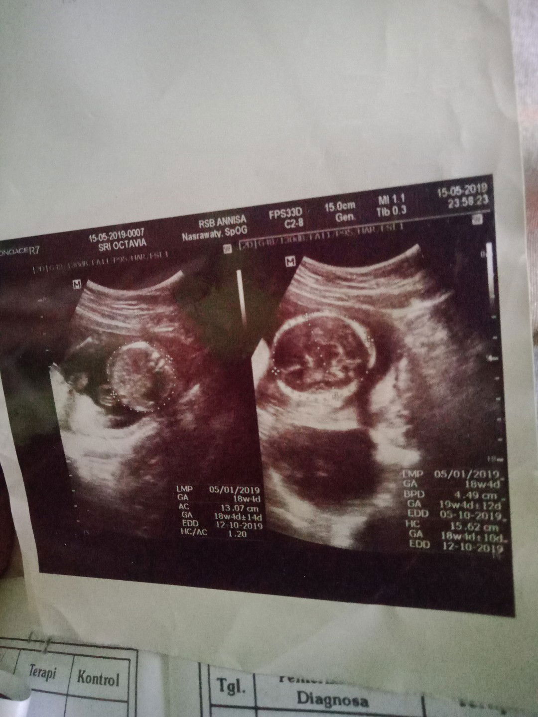 saya mpunyai 3 hpl nih bun yg meragukan dari dokter beda2