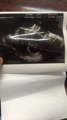 อัลตราซาวน์ครั้งแรกทางช่องคลอดตอน 7 wk 0day เจอเเค่ถุงครรภ์ไม่เจอตัวน้องเครียดมากๆ กลัวเป็นท้องลม มีคุแม่ท่านไหนมีประสพการณ์แบบนี้ รบกวนช่วยแชร์ด้วยนะคะ