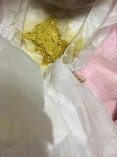 น้องคลอดได้3วันทานนมผสม(นมแม่ยังไม่มา)ถ่ายแบบนี้คืออะไรคะ