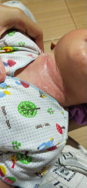 leher bayi merah dan agak lecet