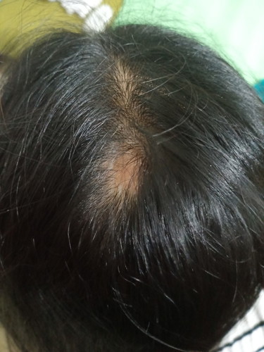 hairfall