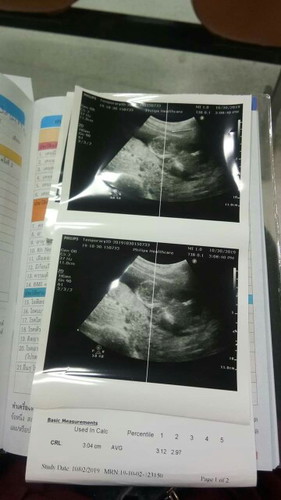 น้องตัวเล็กไปไหมค่ะ 14week