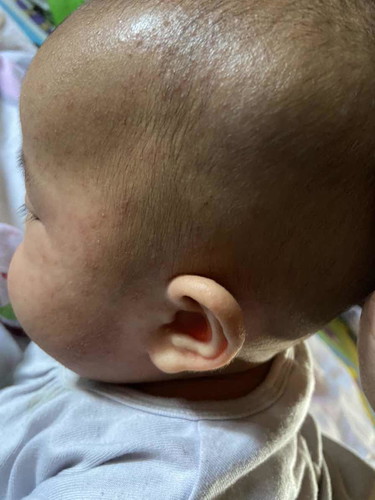 ลูกน้อยผื่นคันไม่หายขาด