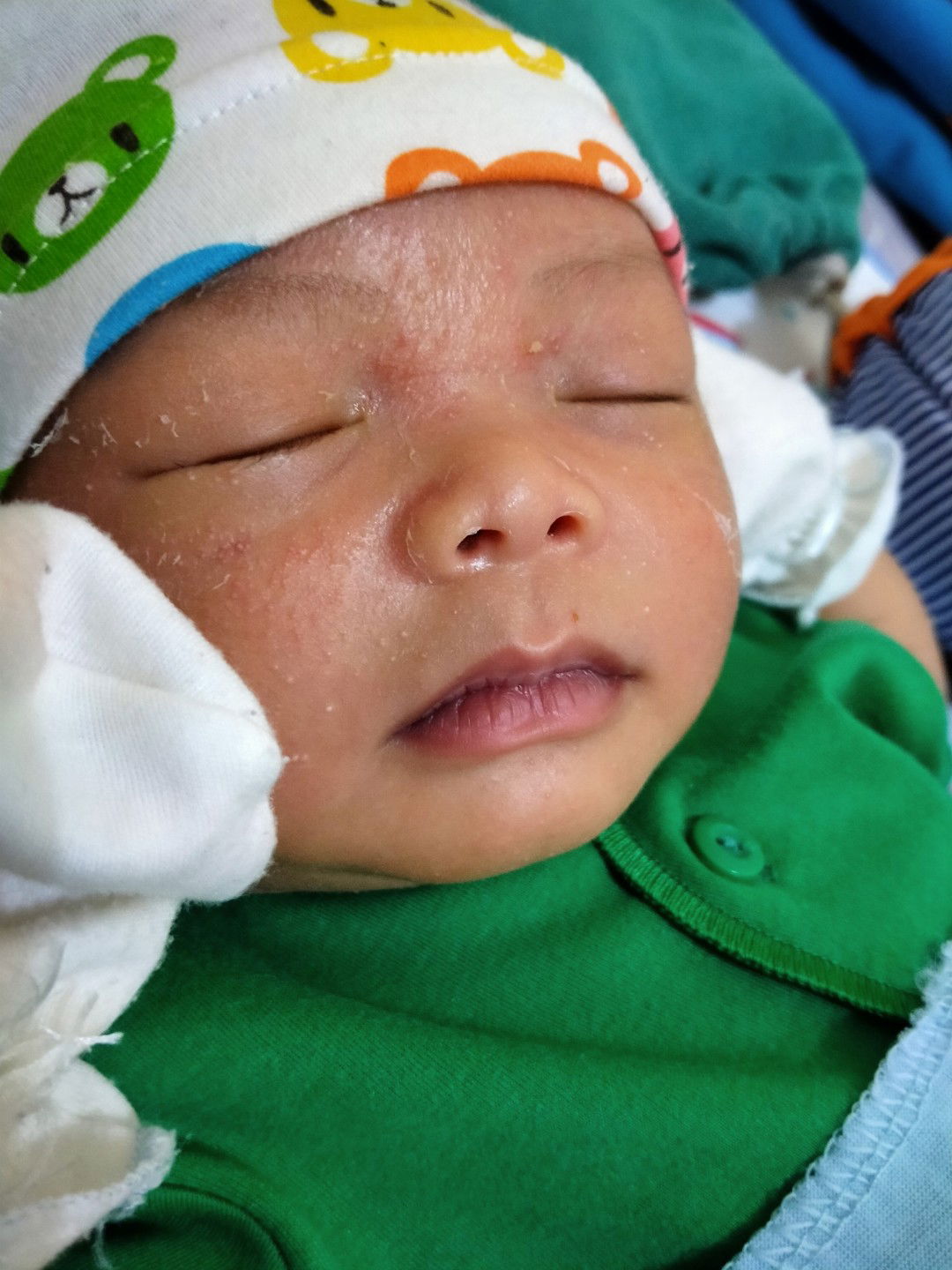 kulit bayi baru lahir terkelupas.