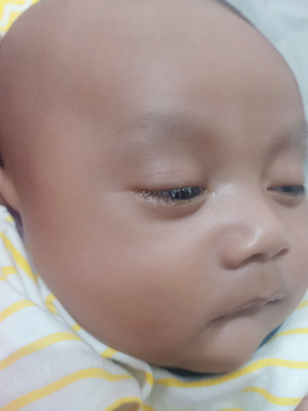 mata berair dan belekan