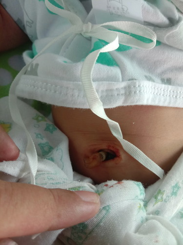 สะบือมีเลือด