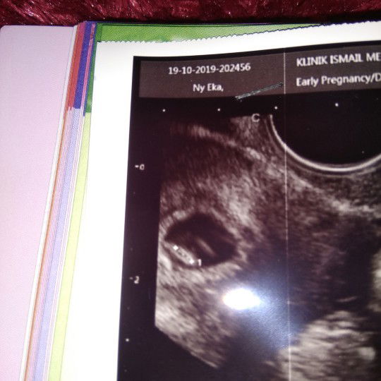 USG Transvaginal 6W1D