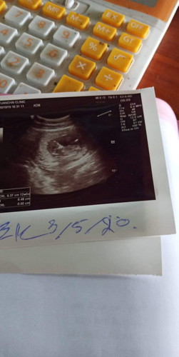 ลูกดิ้นแต่แม่ไม่รู้สึก12w
