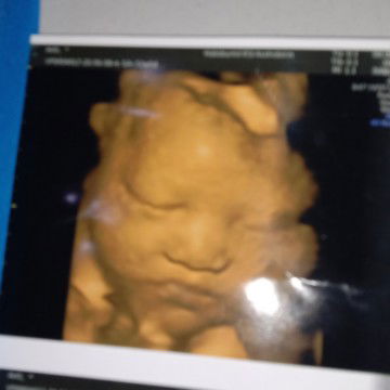Alhamdulilah hasilnya bgus smua smoga smpe persalinan nanti  lancar