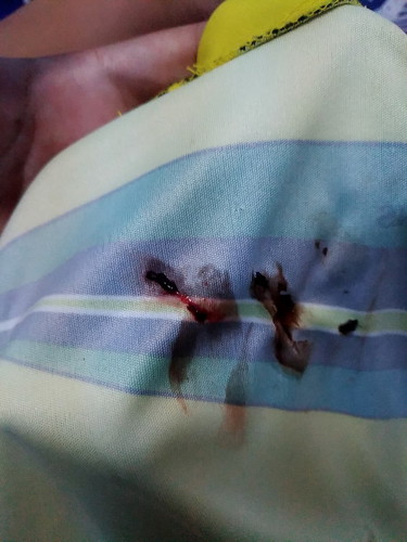 ภาวะแท้งคุกคาม