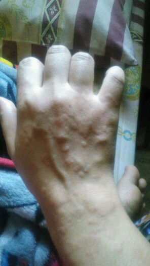 gatal2 pasca melahirkan