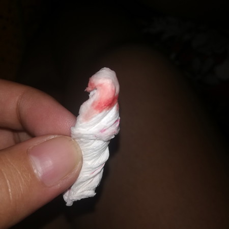 Nose bleed