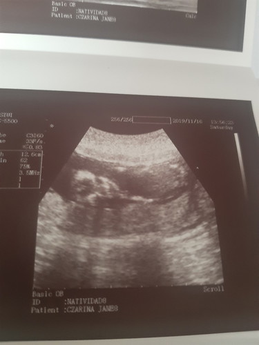 First ultrasound at 14 weeks
