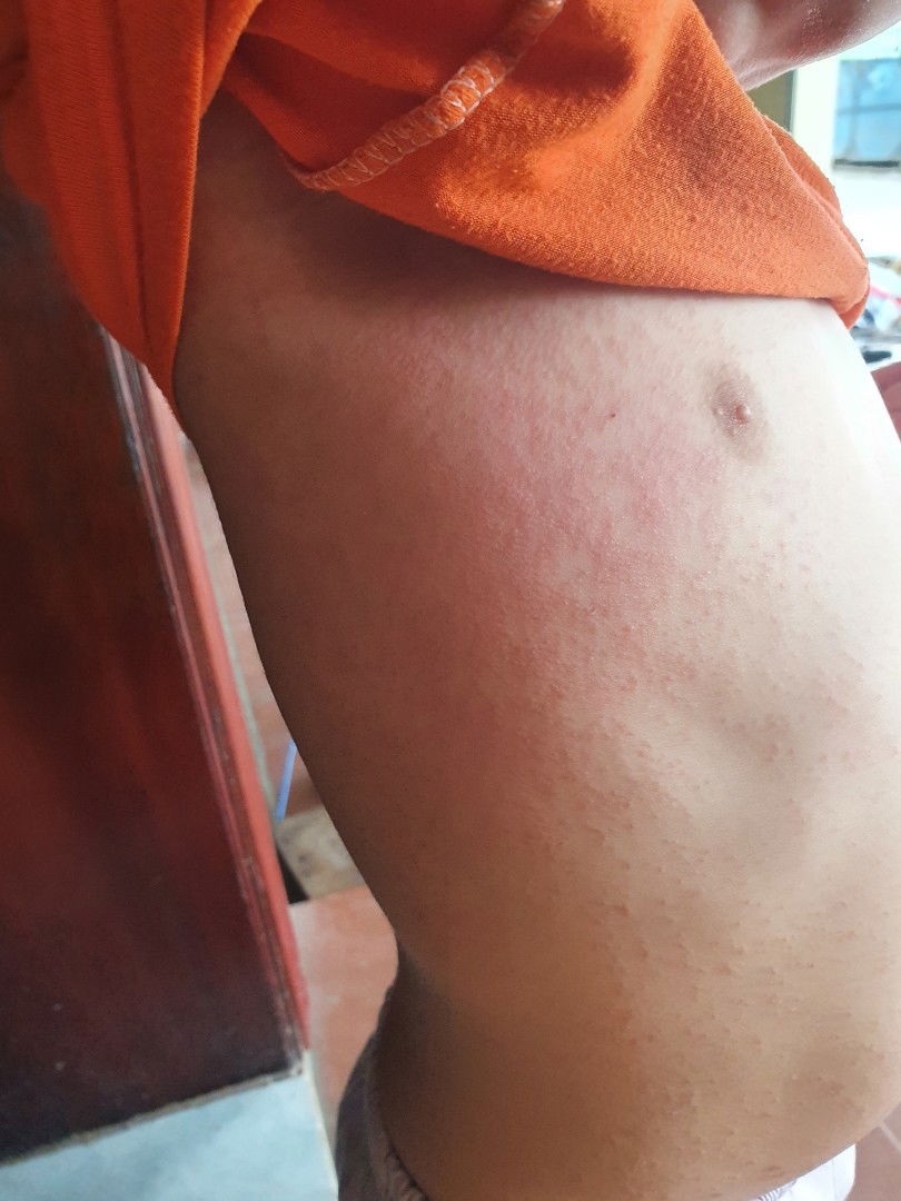 Bé bị nổi nốt