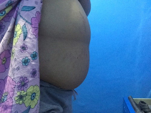 Normal lang ba ito sa matataba na buntis na malaki ang tummy