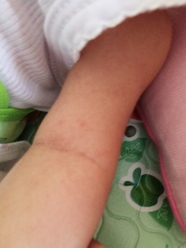 bintik merah di badan bayi