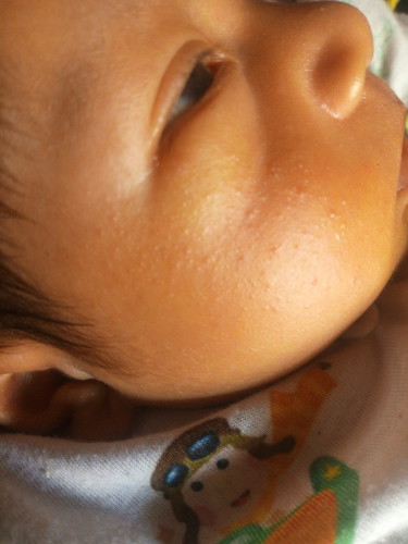 pipi muncul bintik²