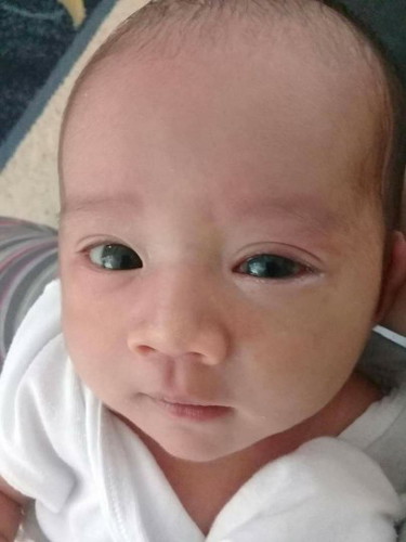 ano pong nangyari sa eyes nya