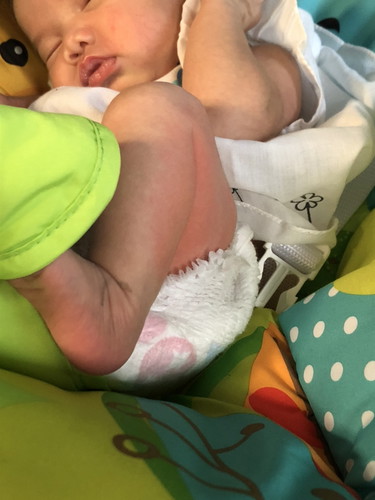 ผื่นเเพ้?