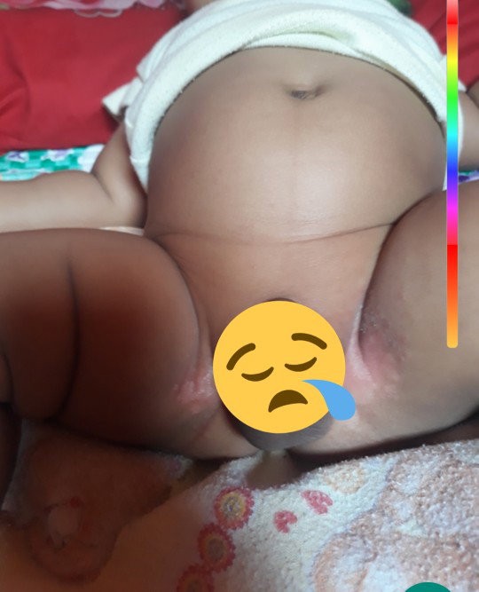 ruam popok kah?