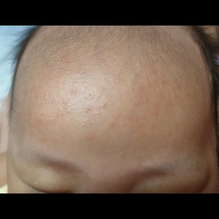 skin rash