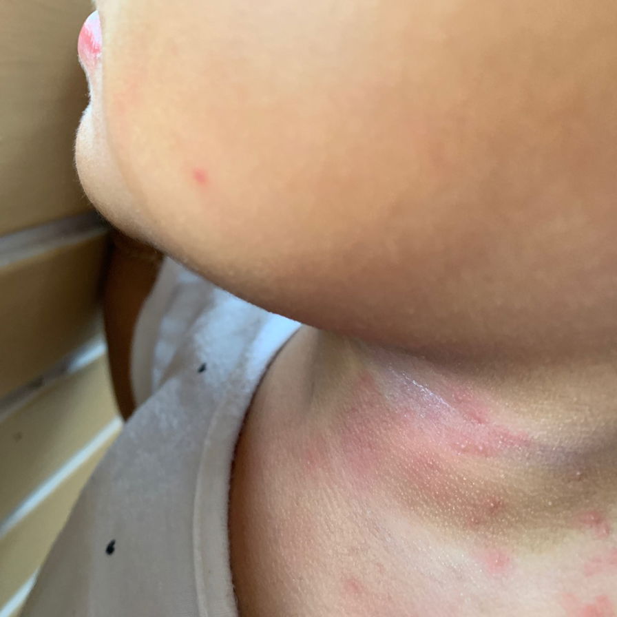 Merah gatal  pada anak