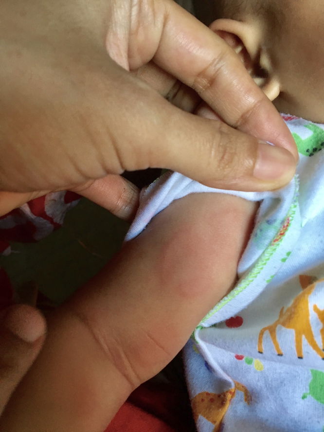 Merah2 pada kulit bayi