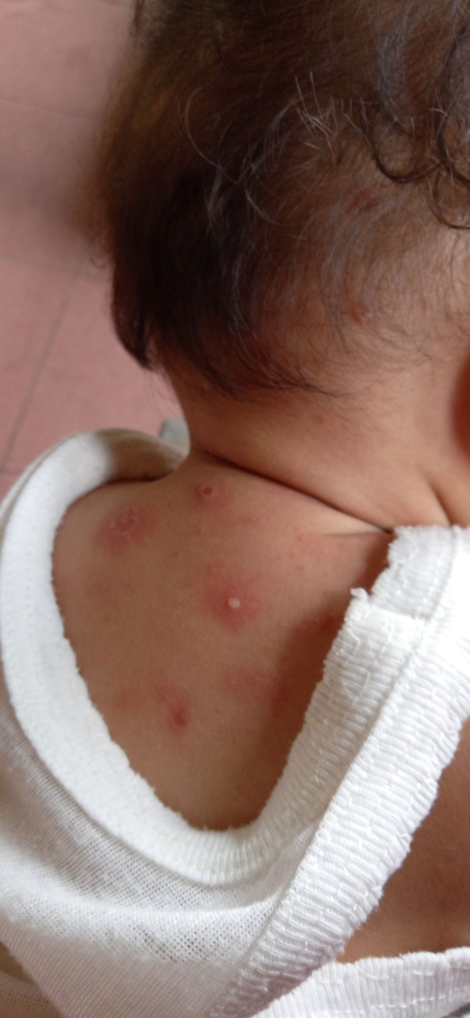 Beruntus berair dan bernanah