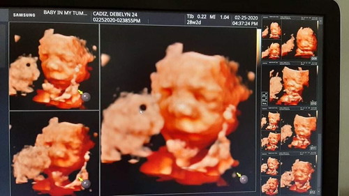 CAS 3d at 28 weeks