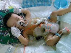 Bayi menjalani Operasi pemotongan usus karena diberi makan belum waktunya