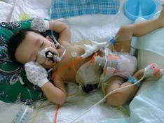 Bayi menjalani Operasi pemotongan usus karena diberi makan belum waktunya