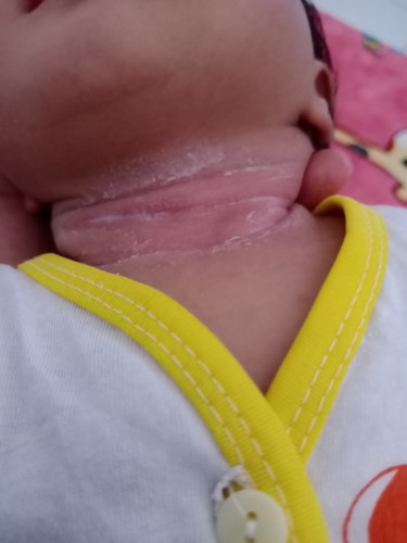 Leher babyku memerah