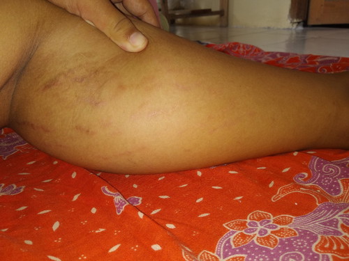 bunda gimana merefakan sakit nyeri di betis dan kaki