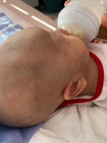 ลูกมีผื่นแดง