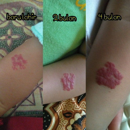 hemangioma