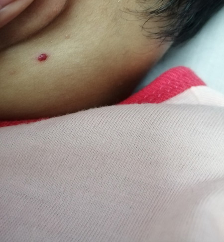 bintik merah belakang telinga