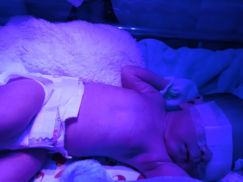 ภาวะตัวเหลือง