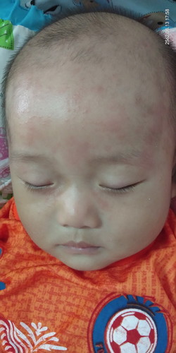 หน้าน้องเป็นผื่นแดงๆ