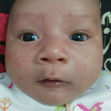 pipi merah seperti jerawat