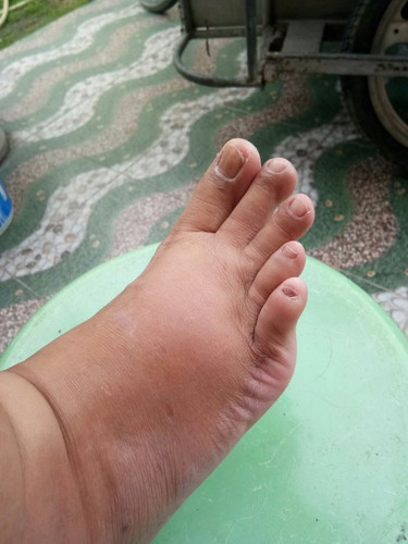 สอบถามหน่อยจ้า ครรภ์17weekเท้าบวม