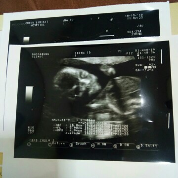 20week แล้วจร้า