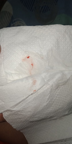 May dugo ng sipon, sipunin at laging hinahatching.