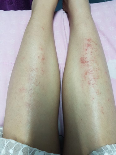 อาการแพ้??