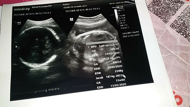 yank mna sbner ya hpl ku ya bun??mw mtk penjelasan bidan nya mlh ada pasien darurat?