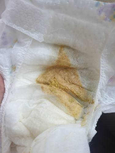 อุจจาระลูกสีซีดลงเป็นอะไรไหมคะ