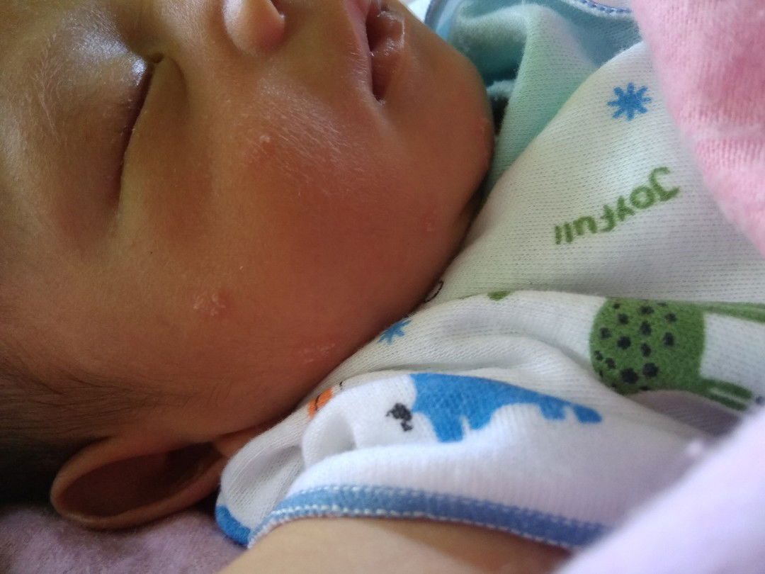 bintik-bintik putih kemerahan di wajah bayi cara ngobatinnya gimana ya ? kasihan saya ?