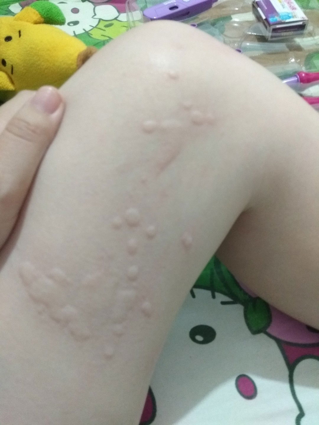 obat alergi biduran buat ibu hamil yang aman apa