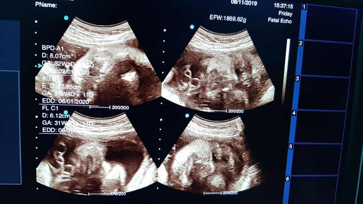 Sedih ketika Bb janin tidak sesuai