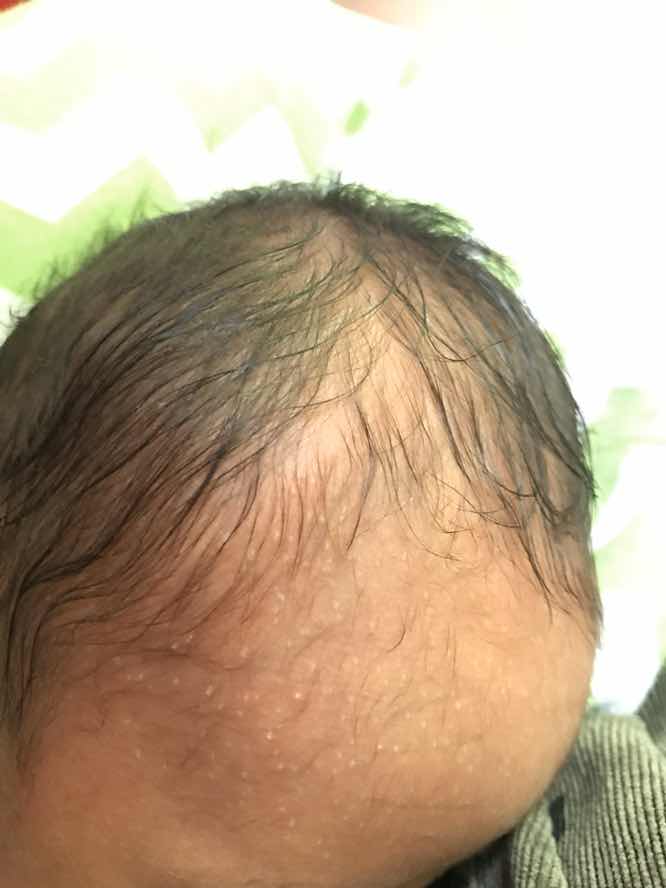 Bintik bintik putih disekitar jidat bayi